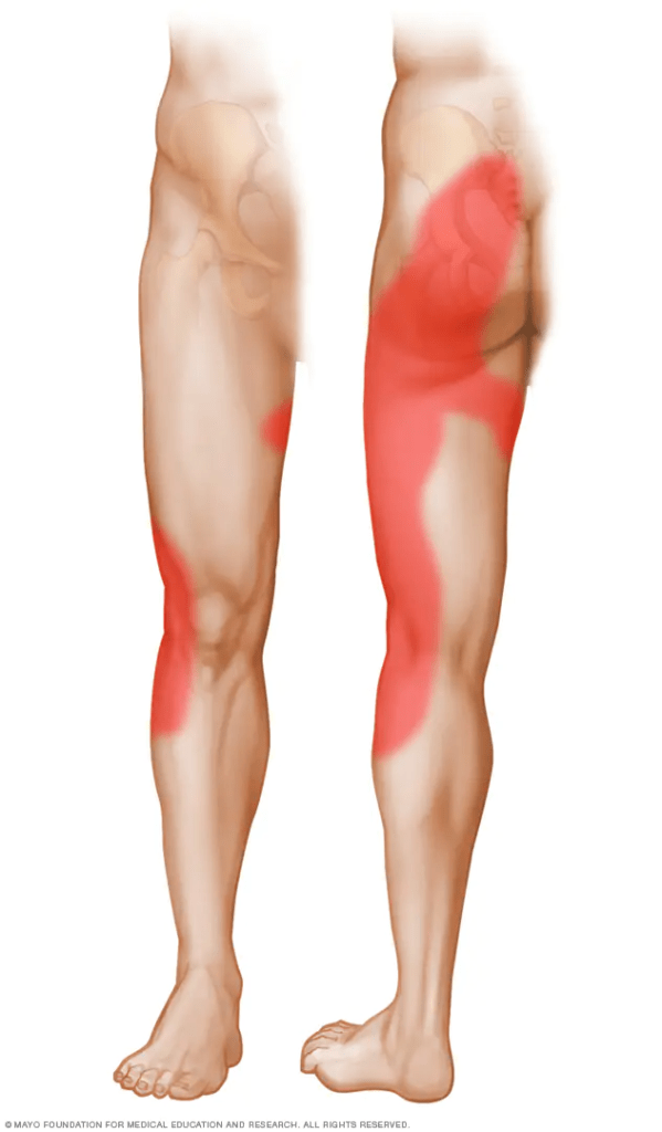 تزریق مفصل ساکروایلیاک 2 تزریق ساکروایلیاک