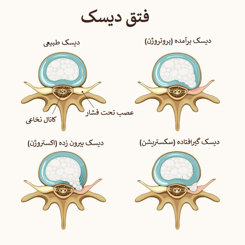 ازون درمانی دیسک 1 فتق دیسک