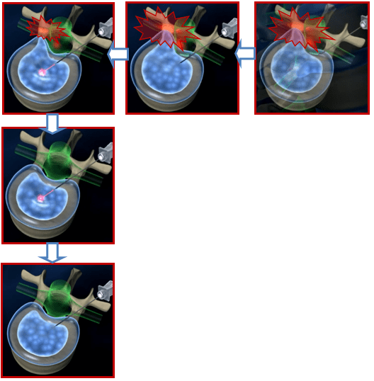 درمان لیزری دیسک 2 نحوه اثربخشی