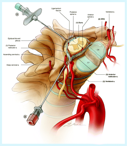 تزریق اپیدورال برای کمردرد و گردندرد 3 داروها و روش های مورد استفاده در تزریق