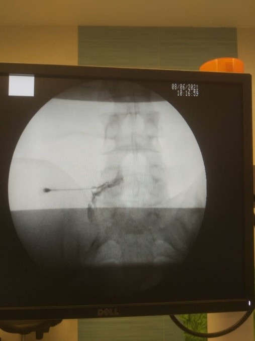 تزریق اپیدورال برای کمردرد و گردندرد 4 نحوه انجام