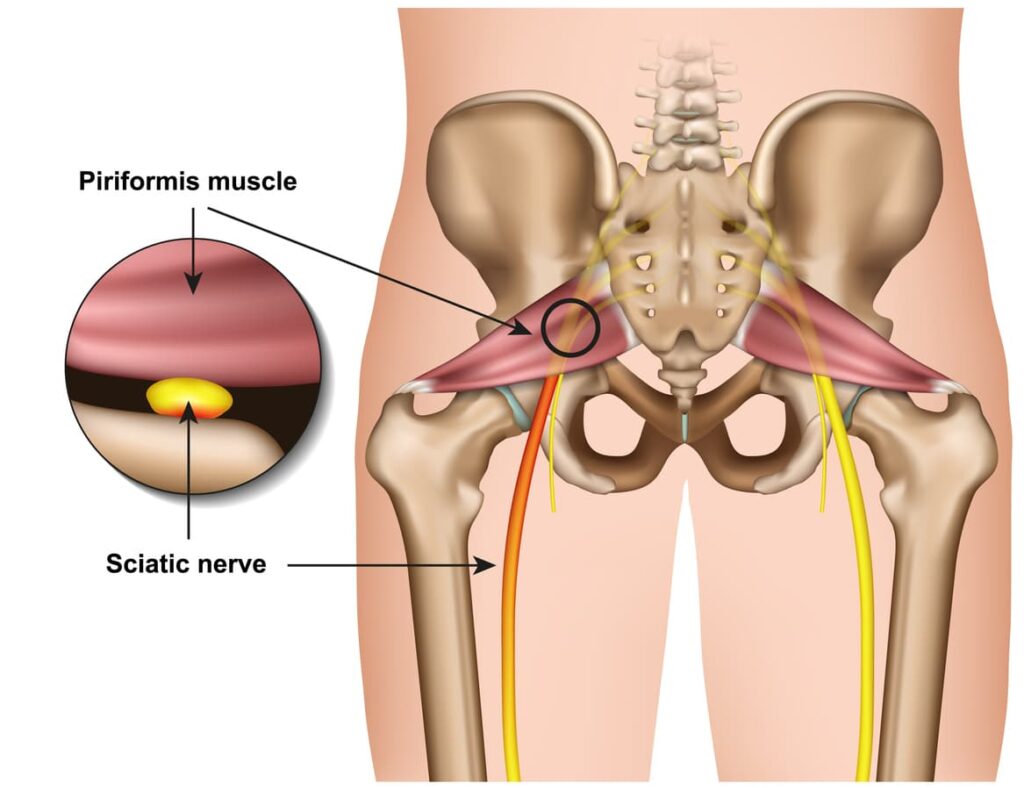 تزریق پیریفورمیس 1 Piriforimis syndrome sciatica diagram