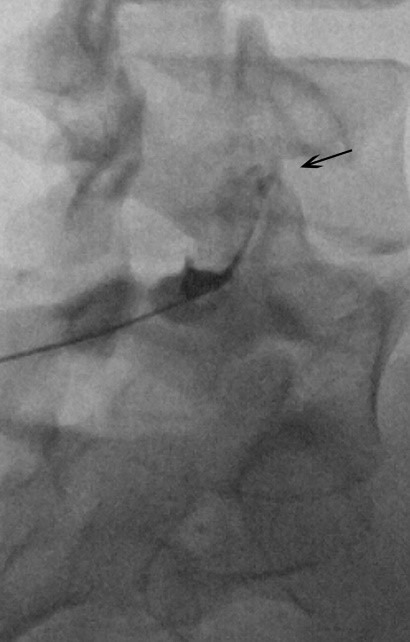 تزریق یا بلوک مفاصل بین مهرهای (فَسِت) 4 facet3