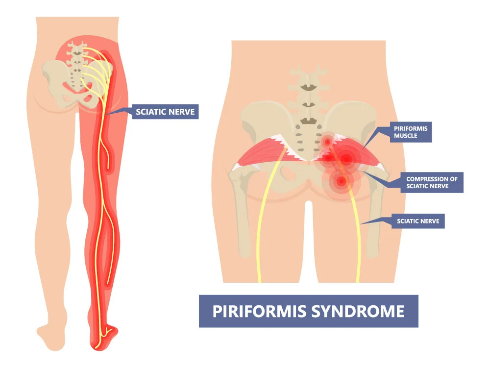 تزریق پیریفورمیس 2 piriformis injection